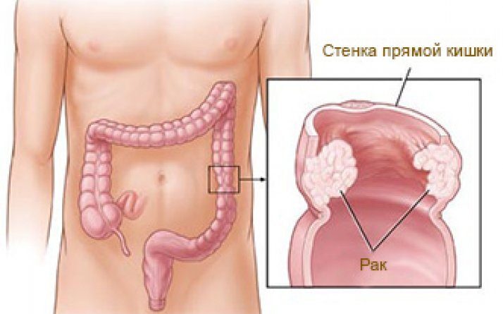 Рак толстой кишки картинки